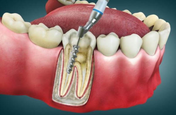 Nguyên nhân gây đau răng sau khi lấy tủy