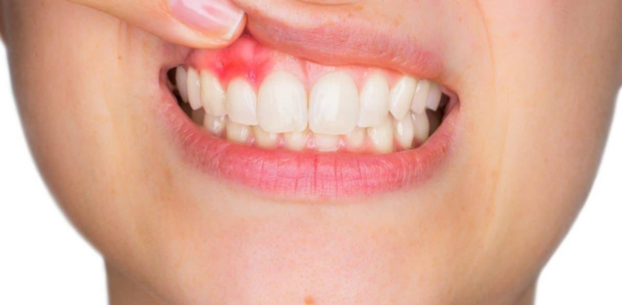 Có bao nhiêu phương pháp điều trị áp xe răng?