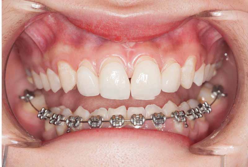 Niềng răng 1 hàm được không?