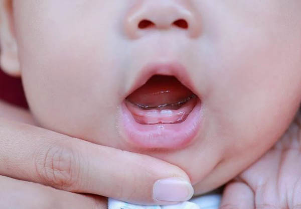 Dấu hiệu và hình ảnh nhận biết lợi trẻ sắp mọc răng hàm