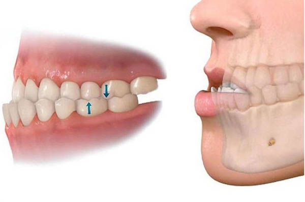 Tổng quan về khớp cắn ngược là gì?