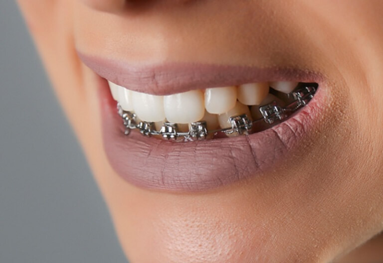 Những lưu ý trước khi quyết định niềng răng 1 hàm là gì?