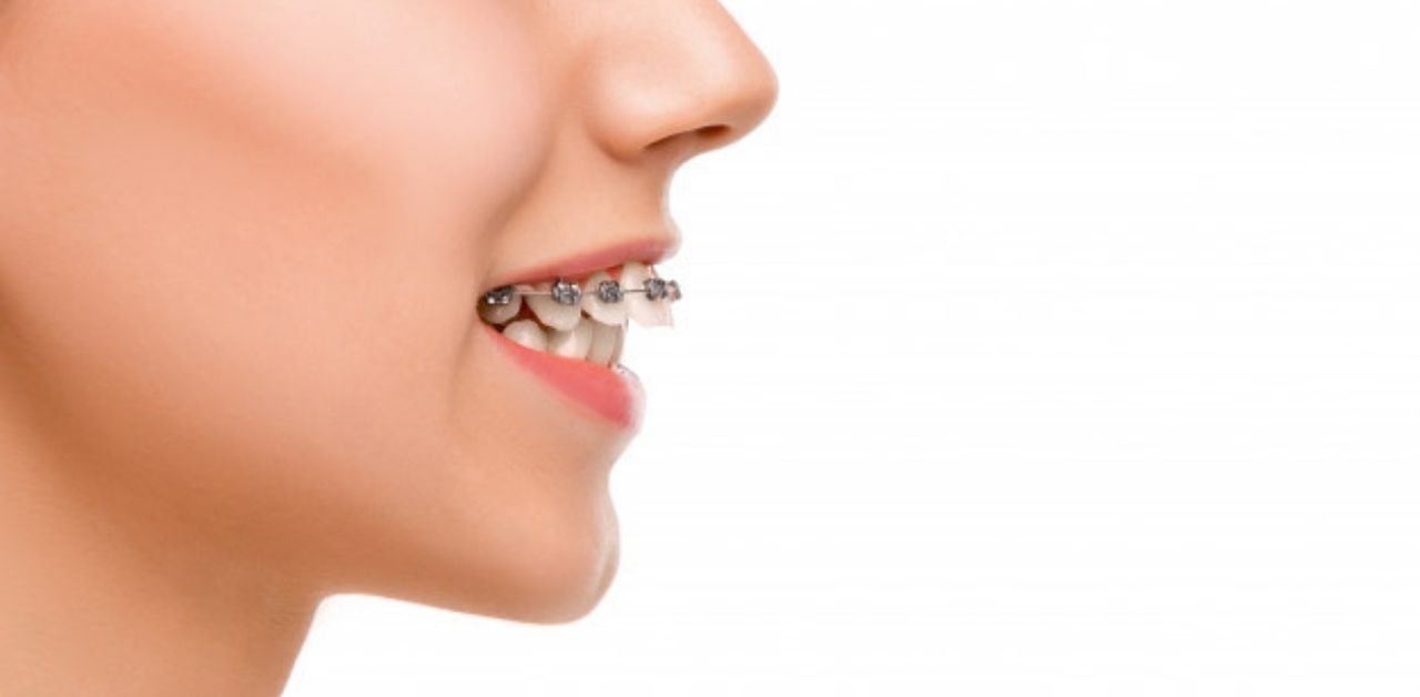 Niềng răng 1 hàm ảnh hưởng như thế nào đến khớp cắn và thẩm mỹ?