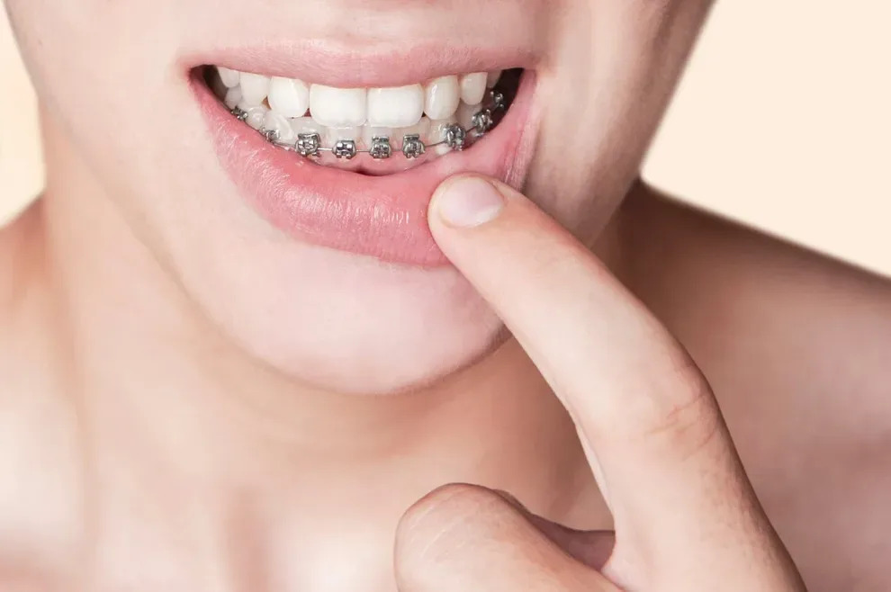 Ưu và nhược điểm của niềng răng 1 hàm là gì?