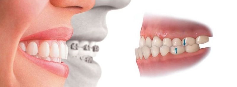 Có bao nhiêu phương pháp điều trị răng móm?