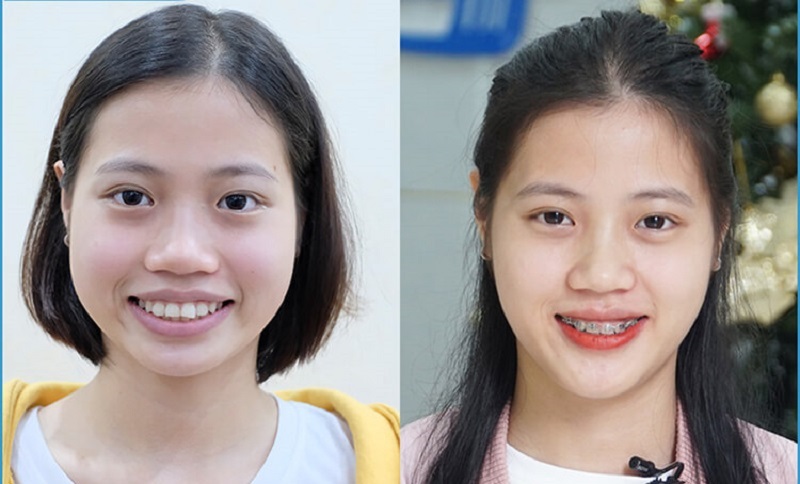 Niềng răng kim loại giúp khuôn mặt thon gọn hơn