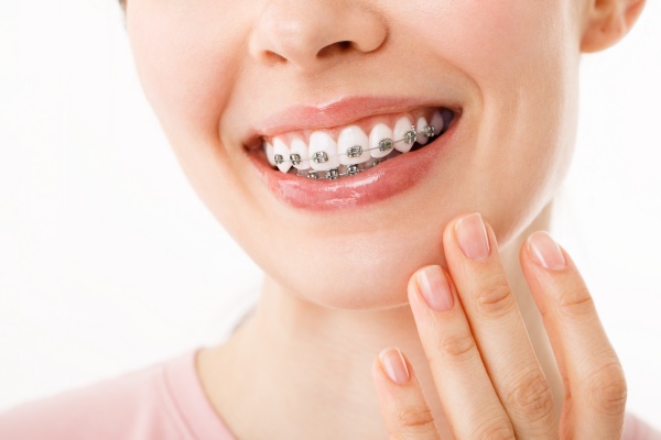Những điều cần lưu ý khi niềng răng là gì?