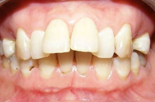 Tổng quan về răng hô