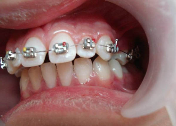 Niềng răng giúp điều trị răng hô nặng hiện nay