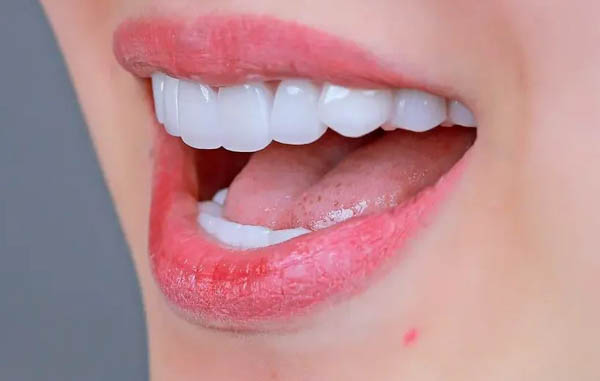Các phương pháp làm răng khểnh giả phổ biến hiện nay
