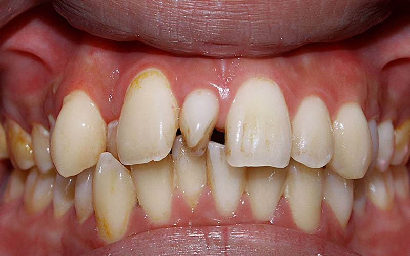Răng lồi xỉ là gì?