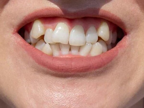 Thời gian điều trị răng lồi xỉ mất bao lâu?