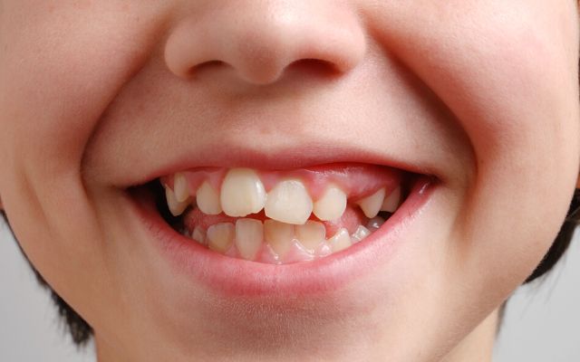 Triệu chứng thường gặp khi bị răng lồi xỉ là gì?