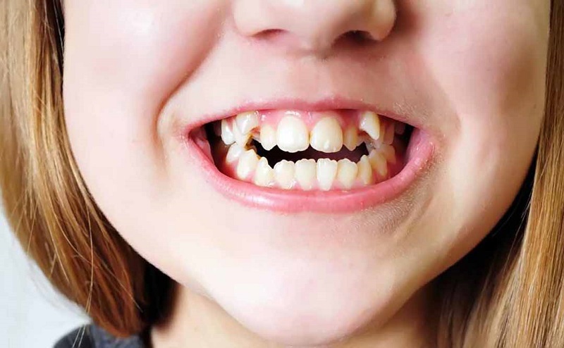 Răng lồi xỉ có nguy hiểm hay không?