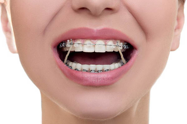 Tác dụng của thun liên hàm trong điều trị chỉnh nha