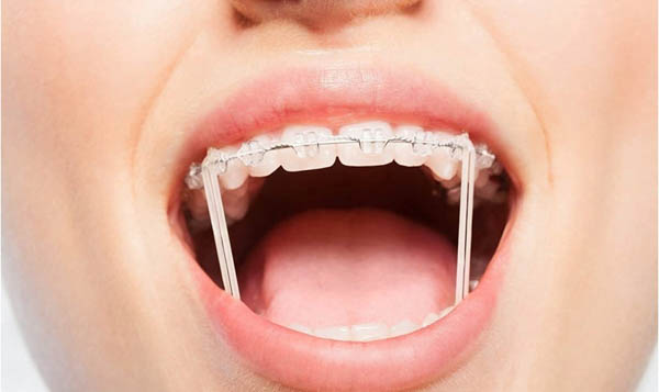 Những lưu ý quan trọng khi đeo thun liên hàm