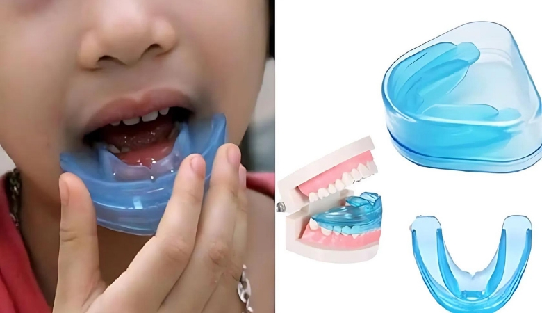 Ưu điểm của niềng răng silicon