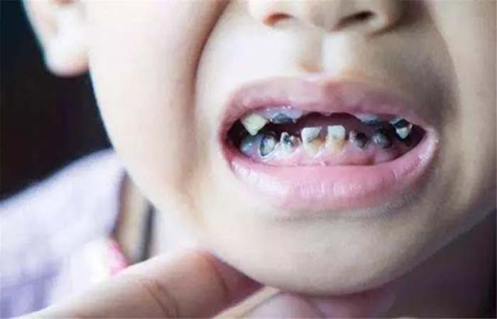 Nguyên nhân gây sâu răng sữa là gì?