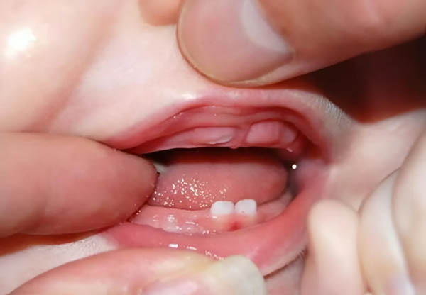 Hiện tượng trẻ sốt khi mọc răng là gì?