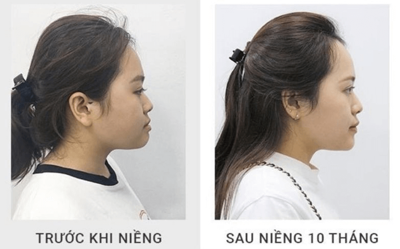 Những thay đổi quan trọng trước và sau khi niềng răng