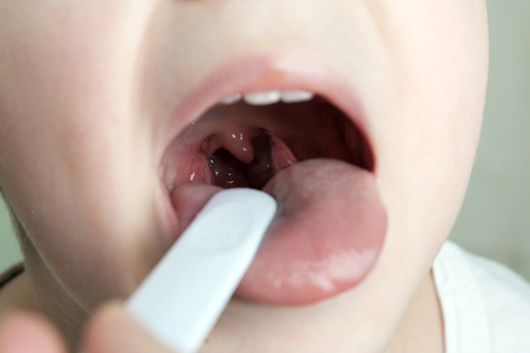 Cách điều trị viêm niêm mạc làm sao hiệu quả nhất?