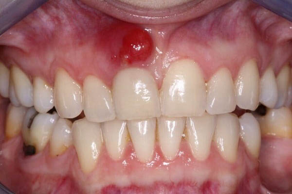 Tổng quan về tình trạng viêm lợi có mủ là gì?