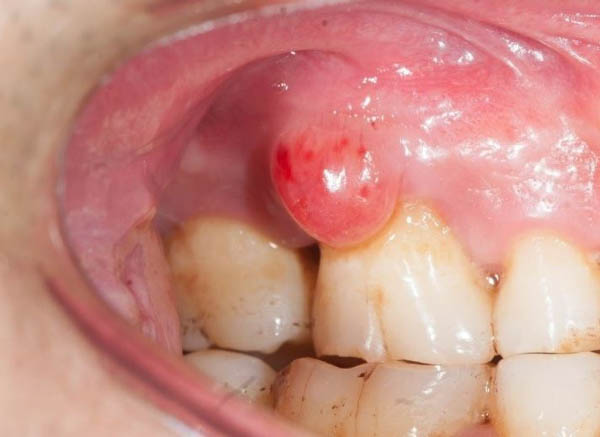 Dấu hiệu và triệu chứng nhận biết viêm lợi có mủ