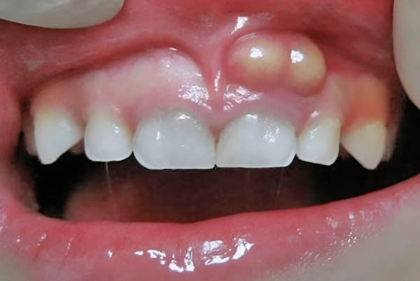 Ảnh hưởng và biến chứng nguy hiểm của viêm lợi có mủ nếu không điều trị
