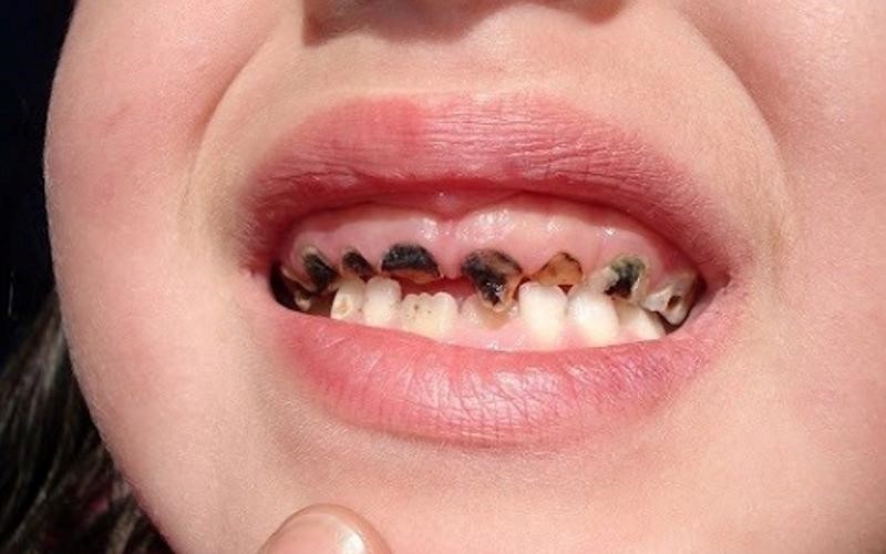 Đối tượng dễ mắc xiết ăn răng nhất là ai?