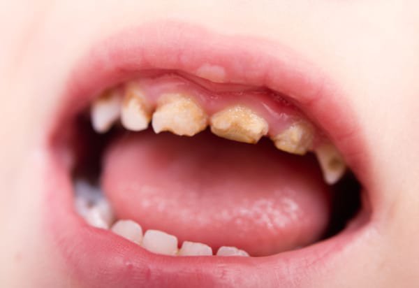 Các phương pháp điều trị xiết ăn răng tạm thời tại nhà