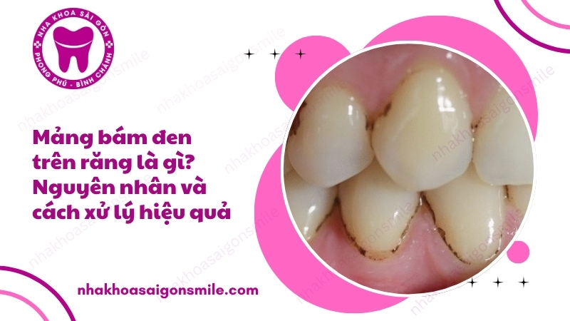 112. Mang bam den tren rang la gi Nguyen nhan va cach xu ly hieu qua