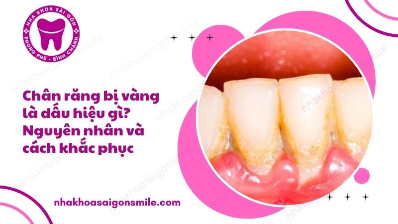 113. Chan rang bi vang la dau hieu gi Nguyen nhan va cach khac phuc