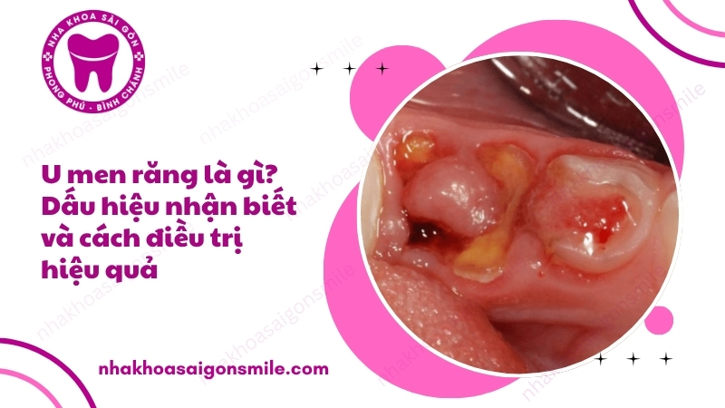 115. U men rang la gi Dau hieu nhan biet va cach dieu tri hieu qua