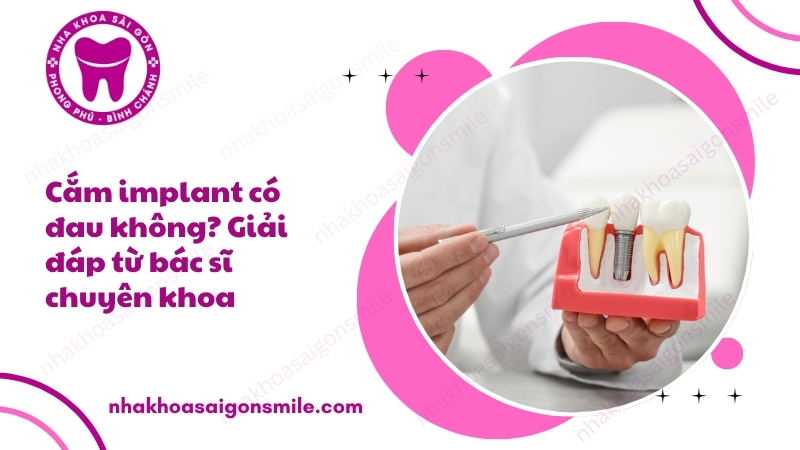 116. Cam implant co dau khong Giai dap tu bac si chuyen khoa