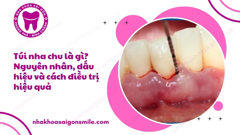 121. Tui nha chu la gi Nguyen nhan dau hieu va cach dieu tri hieu qua