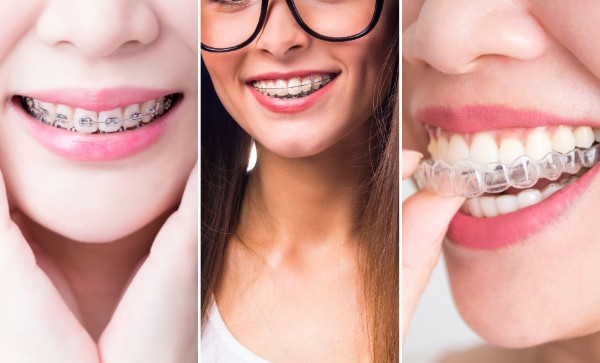 Các phương pháp niềng răng phù hợp cho người 40 tuổi