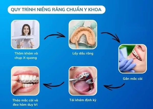 Quy trình niềng răng ở tuổi 40
