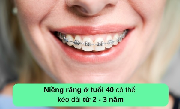 Niềng răng ở tuổi 40 có thể kéo dài từ 2-3 năm