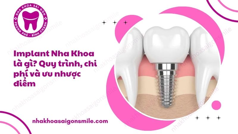 92. Implant Nha Khoa la gi Quy trinh chi phi va uu nhuoc diem
