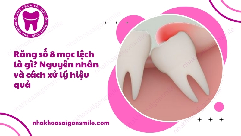 94. Rang so 8 moc lech la gi Nguyen nhan va cach xu ly hieu qua