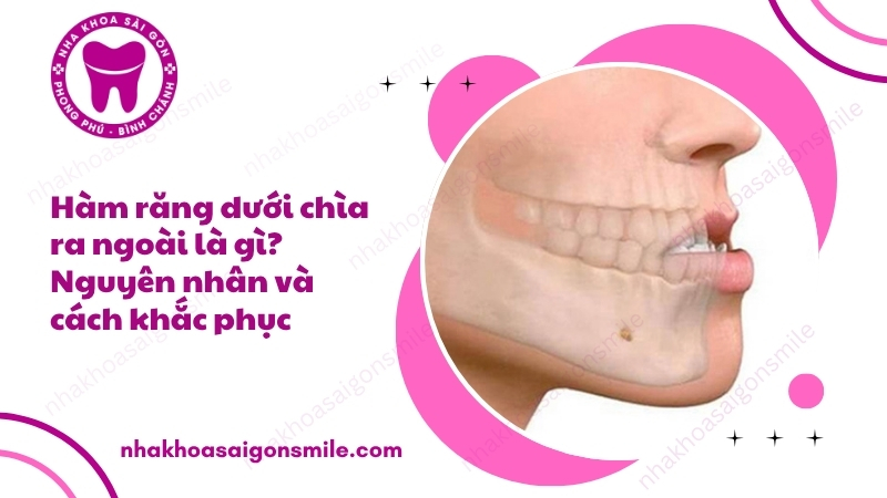 99. Ham rang duoi chia ra ngoai la gi Nguyen nhan va cach khac phuc