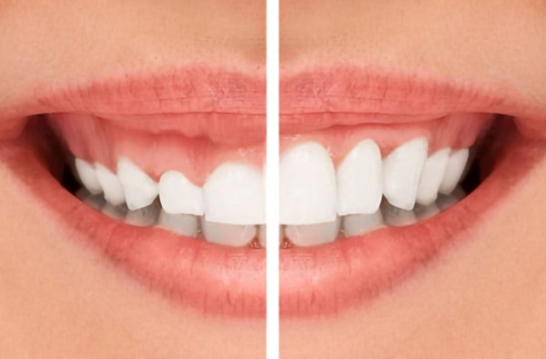 Cắt lợi là một thủ tục nha khoa chỉnh sửa hình dạng và kích thước của nướu