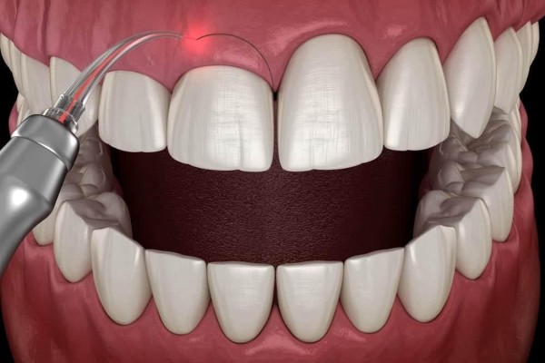 Quy trình thực hiện cắt lợi 