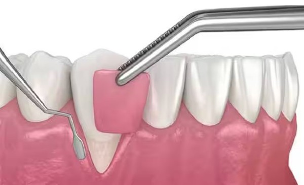 Cắt lợi có đau không? Thực tế cảm giác đau khi cắt lợi