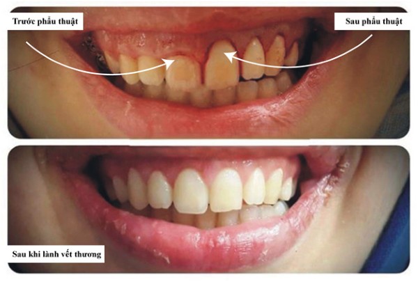 Câu hỏi thường gặp liên quan đến cắt lợi có đau không