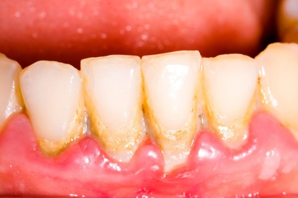 Chân răng bị vàng do tích tụ mảng bám và cao răng