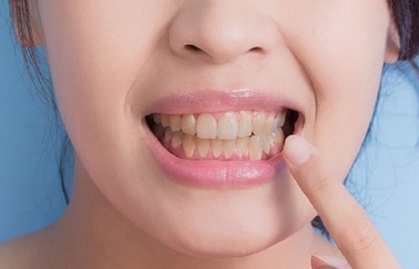 Dấu hiệu nhận biết và tác hại của hiện tượng chân răng bị vàng