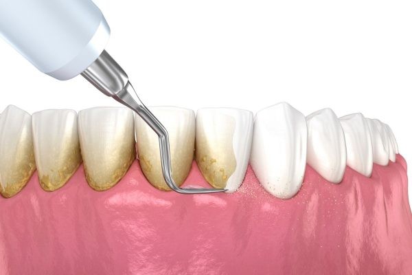 Lấy cao răng là biện pháp điều trị chân răng bị vàng cơ hiệu quả