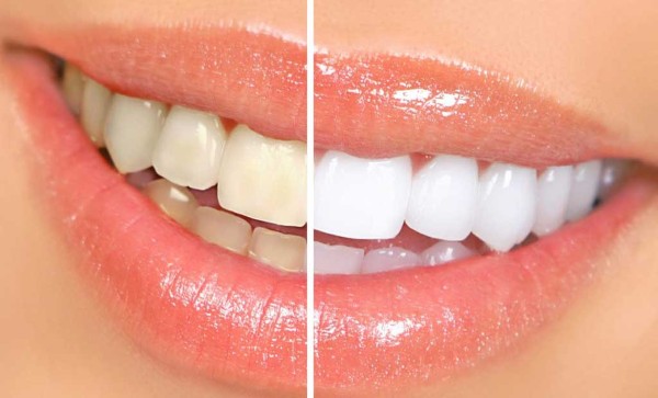 Tẩy trắng răng là một giải pháp hữu hiệu để khắc phục tình trạng chân răng bị vàng