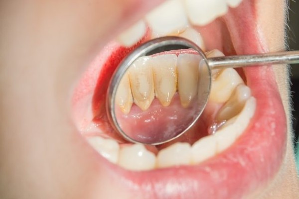 Các câu hỏi thường gặp về tình trạng chân răng bị vàng 